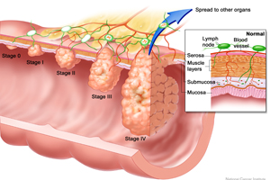 Colorectal cancer, which is the second leading cancer killer in the U.S., begins in the colon.