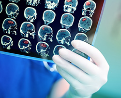 Brain health – keeping us safe from disabling stroke