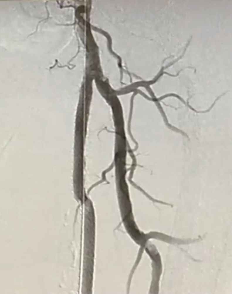 Arteries during PAD procedure