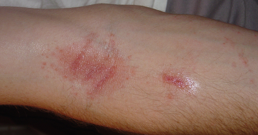 arm with skin rash
