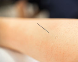 Dry Needling: Another Tool in a Physical Therapist’s Toolbox