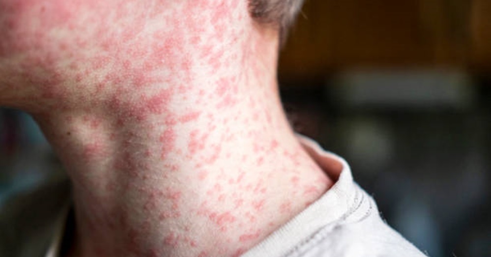 man's neck with measles rash
