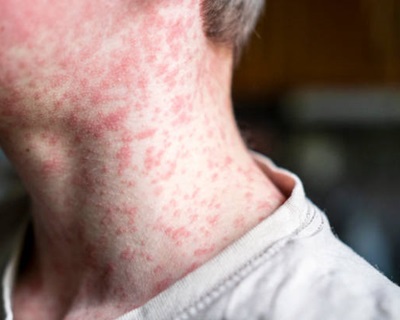 Measles Outbreak: What to Know From The Future of Health