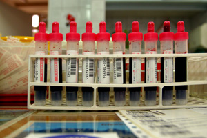 Researchers have discovered that certain markers in a patient's blood do not necessarily mean they will develop RAI.