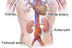 An abdominal aortic aneurysm is a focal enlargement or dilation of the artery in the abdomen.