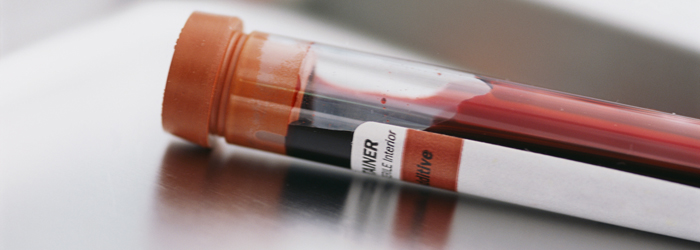Scientists Refine Alzheimer's Simple Blood Test 