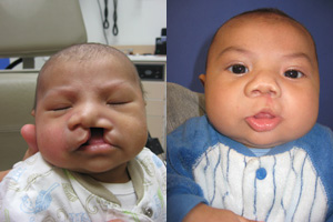 If the lip is open up to and including the floor of the nose, it is called a complete cleft lip.