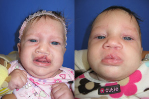 Demke said many parents worry when they first see their baby's cleft lip or palate, but they can typically be closed when the child is 2 to 3 months old.
